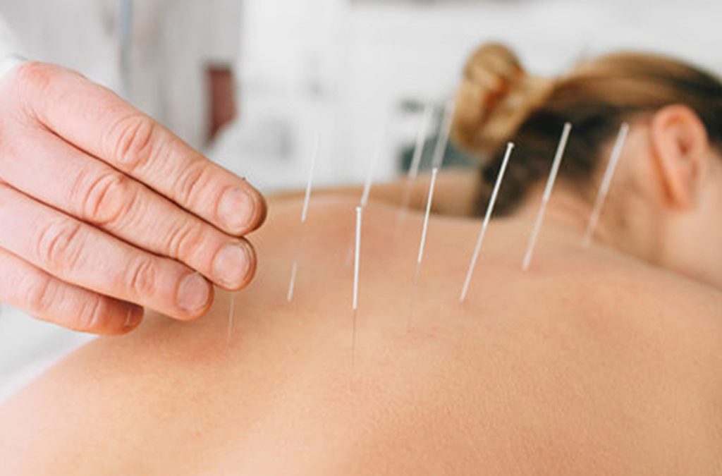 Unlocking Pain Relief with Dry Needling: A Powerful Tool for Healing